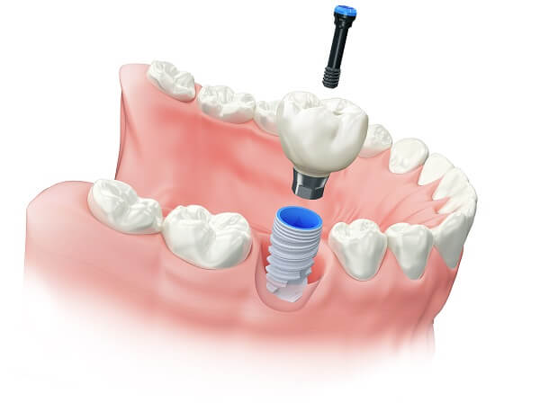 Dental Implants | LAUREL DENTAL Dental Implants | LAUREL DENTAL