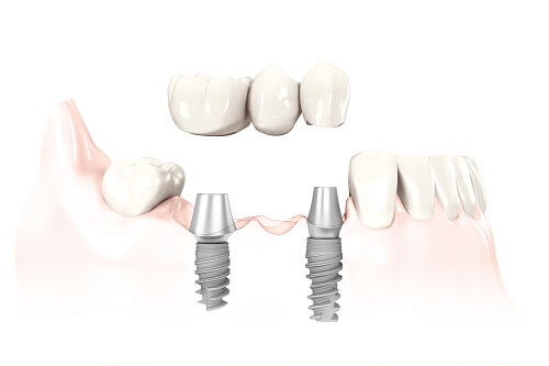 Dental Implants | LAUREL DENTAL Dental Implants | LAUREL DENTAL